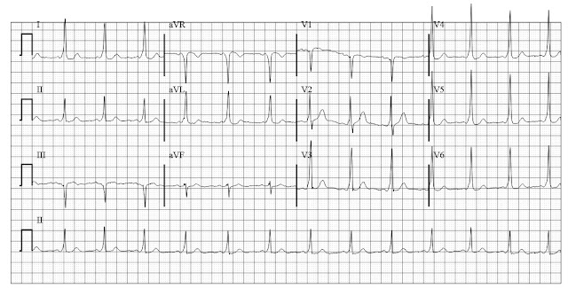 ECG of Wolff Parkinson White syndrome (WPW) with postero-septal bypass tract