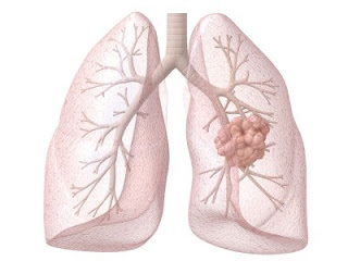 Mesothelioma Lawsuit