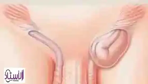 Testicular-hernia-causes-and-symptoms