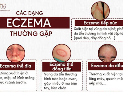 Trieu-chung-cua-benh-eczema