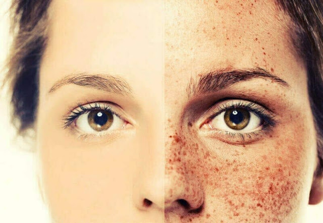 How to Get Rid of Freckles Naturally and Fast ?