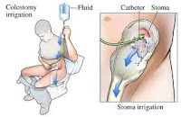 perawatan kolostomi,perawatan lubang kolostomi,Blog Keperawatan