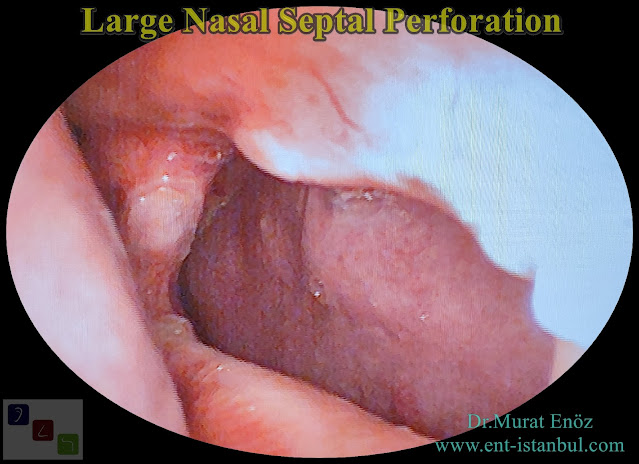 nasal septal hole closure,repairing of  septum perforation, septum perforation surgery in istanbul