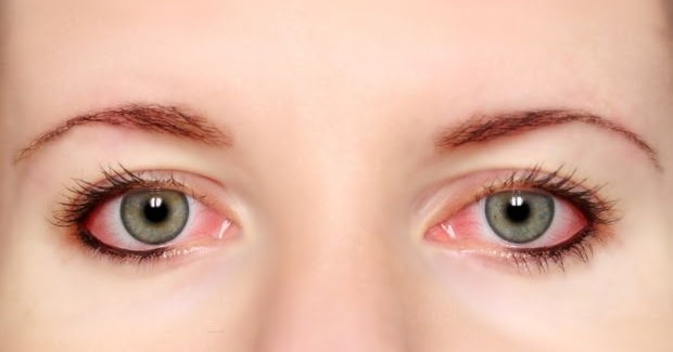 Penyebab Dan Cara  Menghilangkan  Bercak Merah Pada Mata  