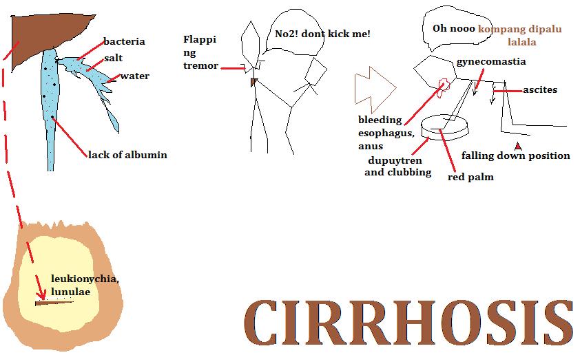 Tonik Hati: Kerosakan Hati Fibrosis / Sirosis hati (Liver 