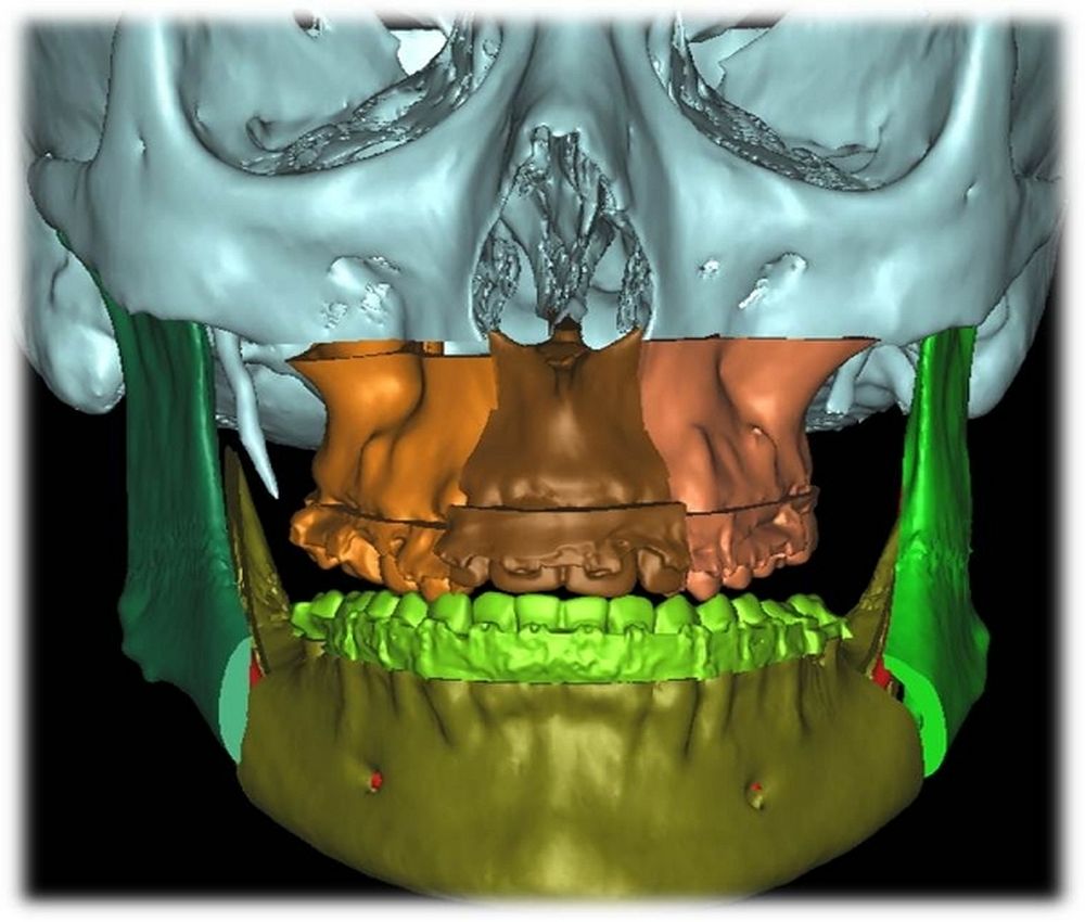 Cirugia maxilofacial