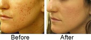 Remove Your acne Blemishes Naturally - Healthy t1ps