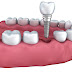 Cấy ghép răng implant có ưu điểm gì?