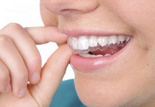 Khay niềng răng invisalign có thể tháo lắp dễ dàng