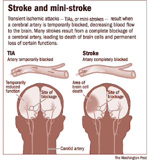 stroke