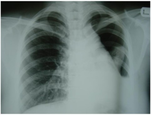 Fig 1: Chest x-ray showing