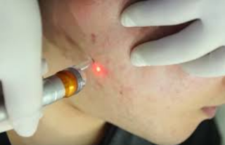 How To Eliminate Acne Scars with Lasers and the Benefits