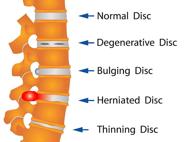 Common Spine Disorders and How They Are Treated