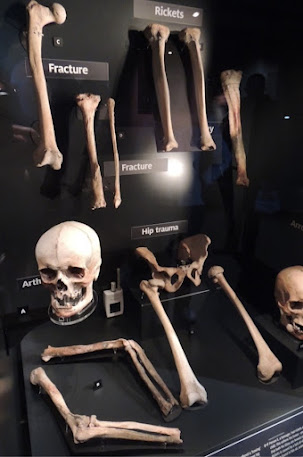 Figure 1 - A display of pathological skeletal specimens from the Mary Rose, Portsmouth. Credit: S Evelyn-Wright (2014)