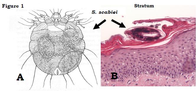 Asuhan Keperawatan Pasien Scabies Lengkap askep