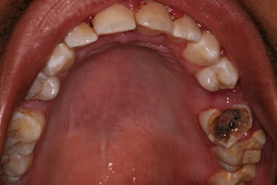 Răng sâu khi nào phải nhổ?