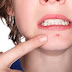 Acne Scar Treatment - 3 Effective Ways To Remove Scars