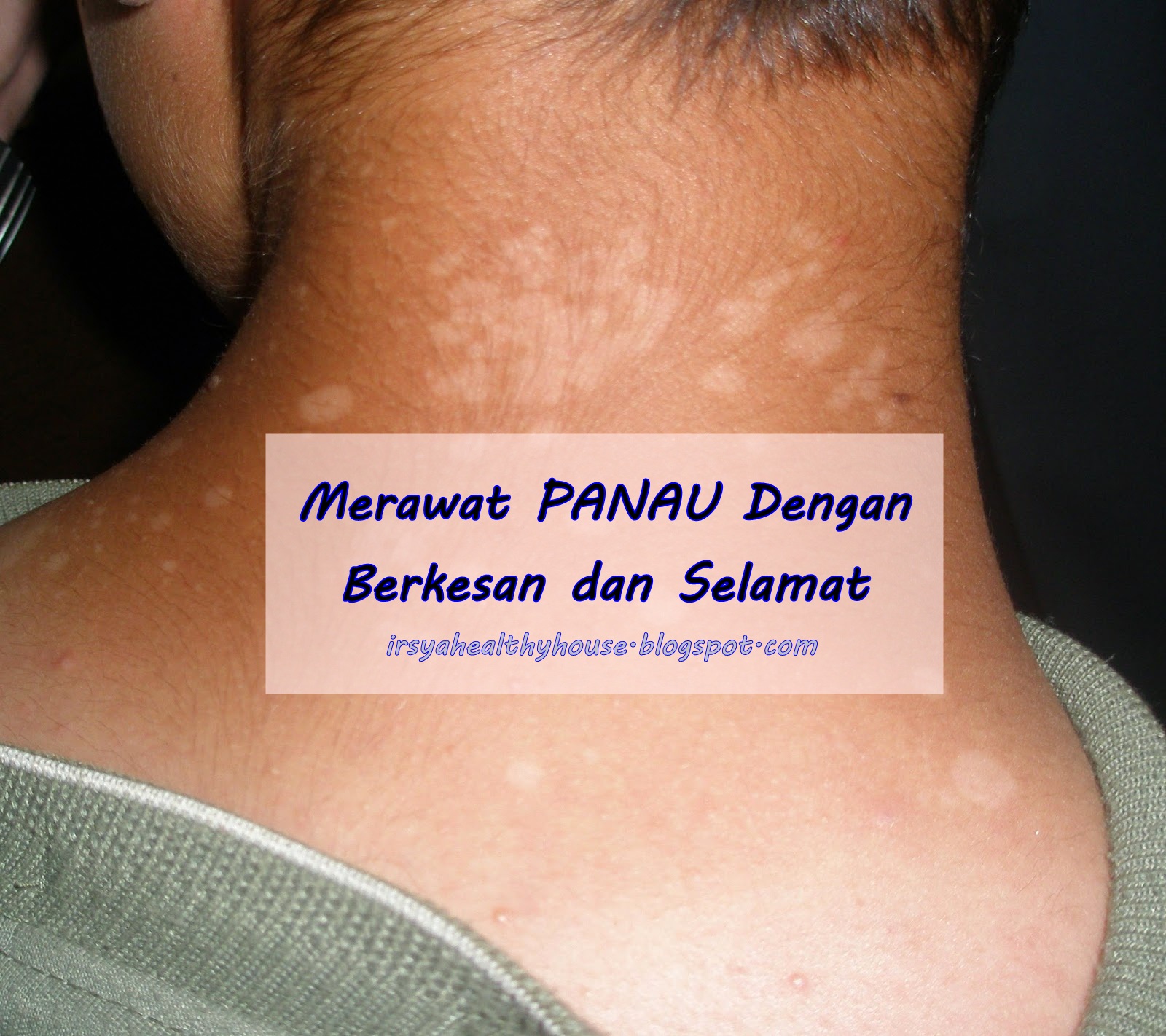 Hilangkan Panau di Muka dan Badan Dengan Berkesan, Elakkan 