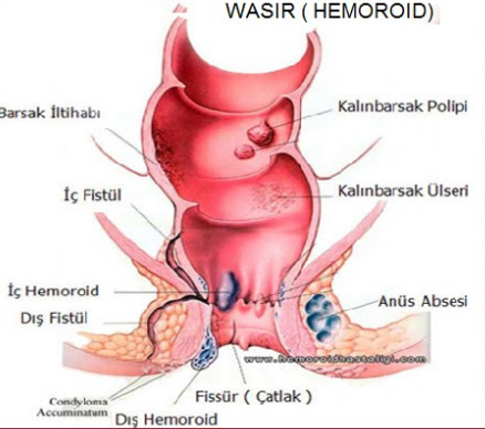 Gejala Wasir, Wasir Stadium 4, Terapi Wasir
