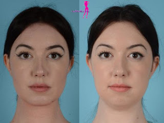 Risks and Complications of Cheek and Chin Liposuction