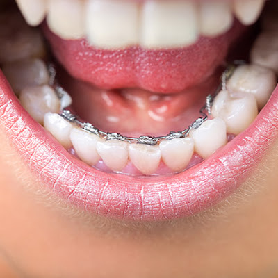 nieng-rang-invisalign-co-mac-khong