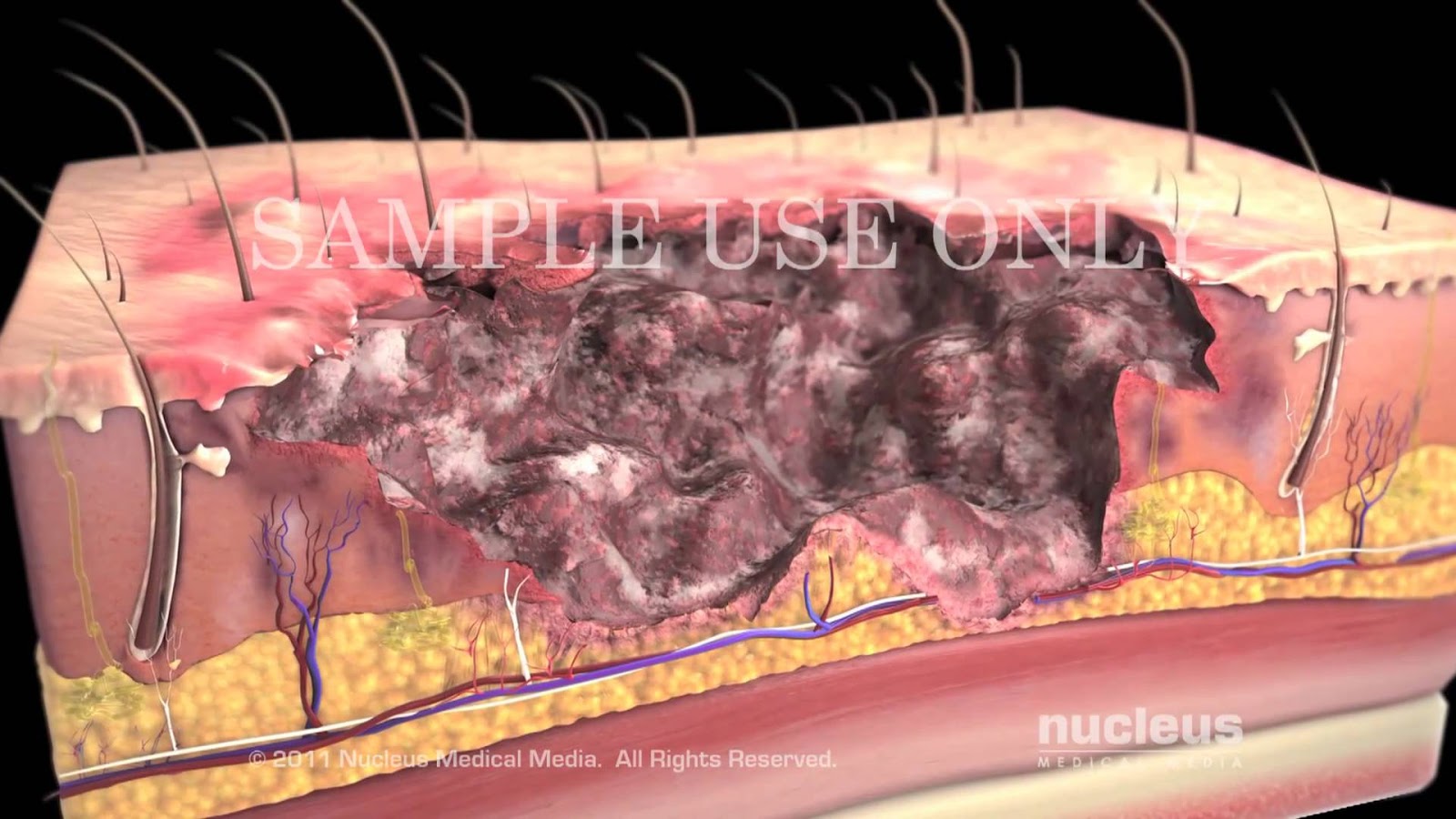 http://pathologyvideos.blogspot.ro/2014/04/burnsclassification-and-treatment.html