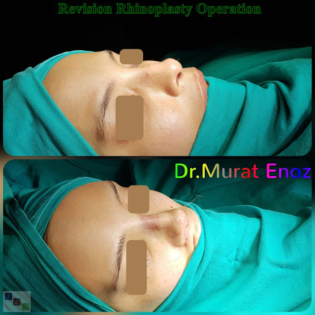 revision rhinoplasty in istanbul