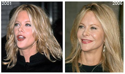 Meg Ryan Plastic Surgery Disaster