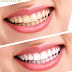 Tẩy trắng hiệu quả với thuốc tẩy trắng răng