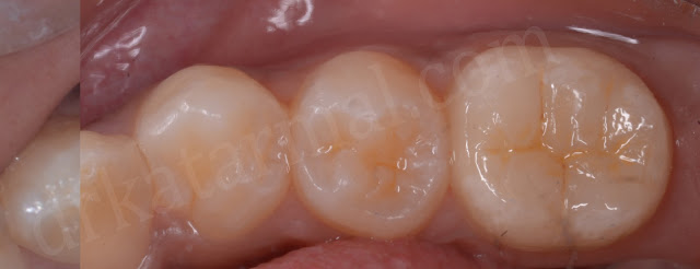 After Bonding of Tabletop Restoration on Molar