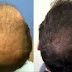 The Hair Loss Protocol Reviews