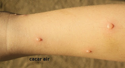 cacar air