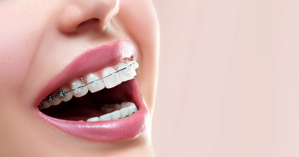 (c) Clearbracesorthodontics2.blogspot.com