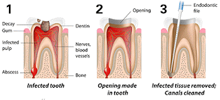 Painless Root Canal Treatment Pitampura