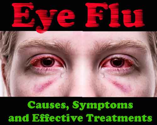 Eye Flu symptoms, Eye Flu treatment, Eye Flu prevention, Eye Flu causes, Eye Flu remedies, Eye Flu in children, Eye Flu in adults, Eye Flu contagious