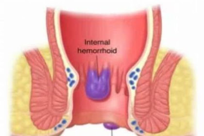 Fastest Removal of Hemorrhoids With These Natural Remedies !