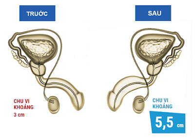 Thuốc tăng kích thước dương vật tốt nhất mà nam giới nên sử dụng