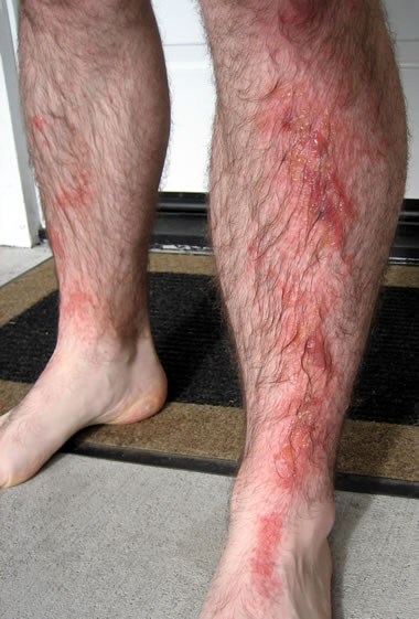 poison ivy rash. poison ivy rash