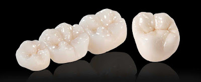 Bọc răng sứ zirconia cần biết