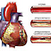 атеросклеротическая болезнь сердца