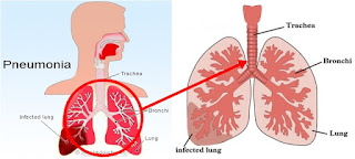 Penyakit Pneumonia