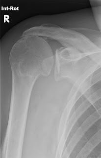 What Could Your Scary Symptoms Mean?: Does a Torn Rotator Cuff Always 
