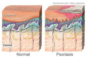3 Types of Psoriasis and the Symptoms
