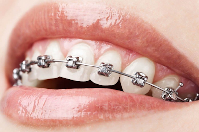 Dental Braces Treatment in Pitampura