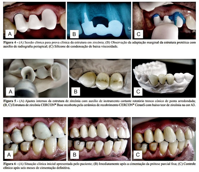 PDF: Reabilitação estética com a utilização de um sistema cerâmico do tipo Y-TZP