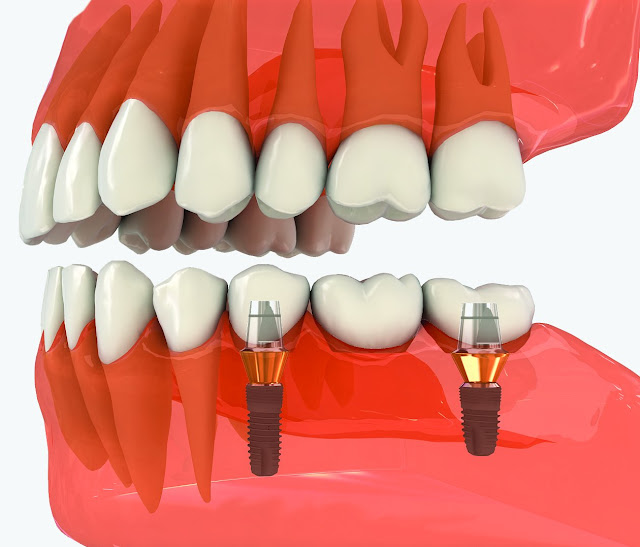 Lời khuyên của bác sĩ sau trồng răng implant