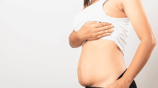 post-pregnancy-tummy-tuck-barbies-beauty-bits