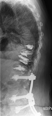 Röntgenbild mit zahlreichen LWK-Frakturen mit Vertebroplastie und Fixateur interne