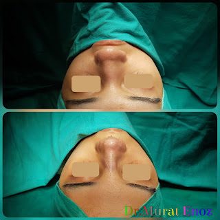 Thick Skin Bulbous Tip Rhinoplasty, Thick Skinned Nose Job, Female Rhinoplasty, Deviated Nose Aesthetic, Ethnic Rhinoplasty