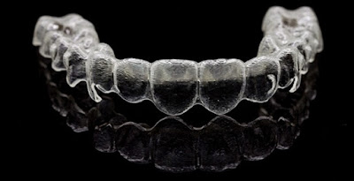 Phương pháp niềng răng không mắc cài 3D Clear 